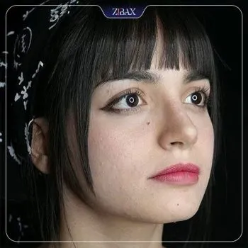 نمونه عمل جراحی بینی دکتر شاهین میلانی — تصویر 3