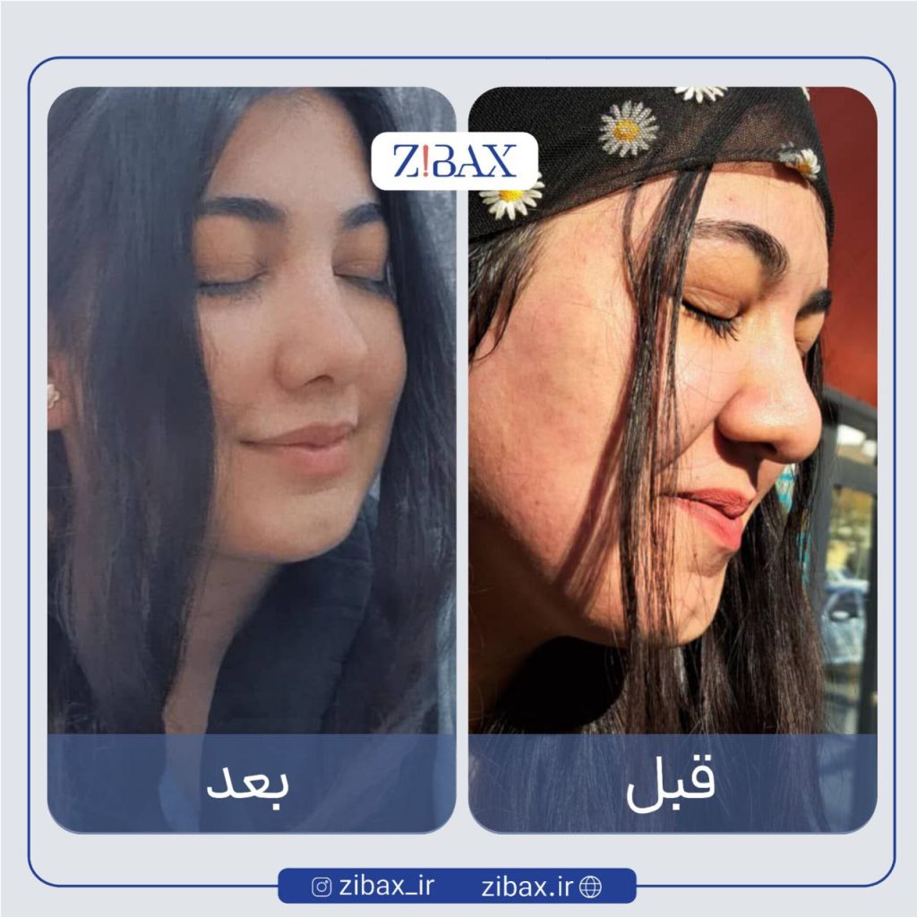 عکس بینی گوشتی قبل از عمل زیبایی با پوست ضخیم و نوک افتاده