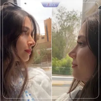 نمونه عمل جراحی بینی دکتر مجتبی ملکی — تصویر 4