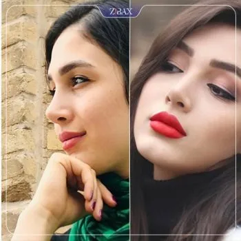 نمونه عمل جراحی بینی دکتر مجتبی ملکی — تصویر 7