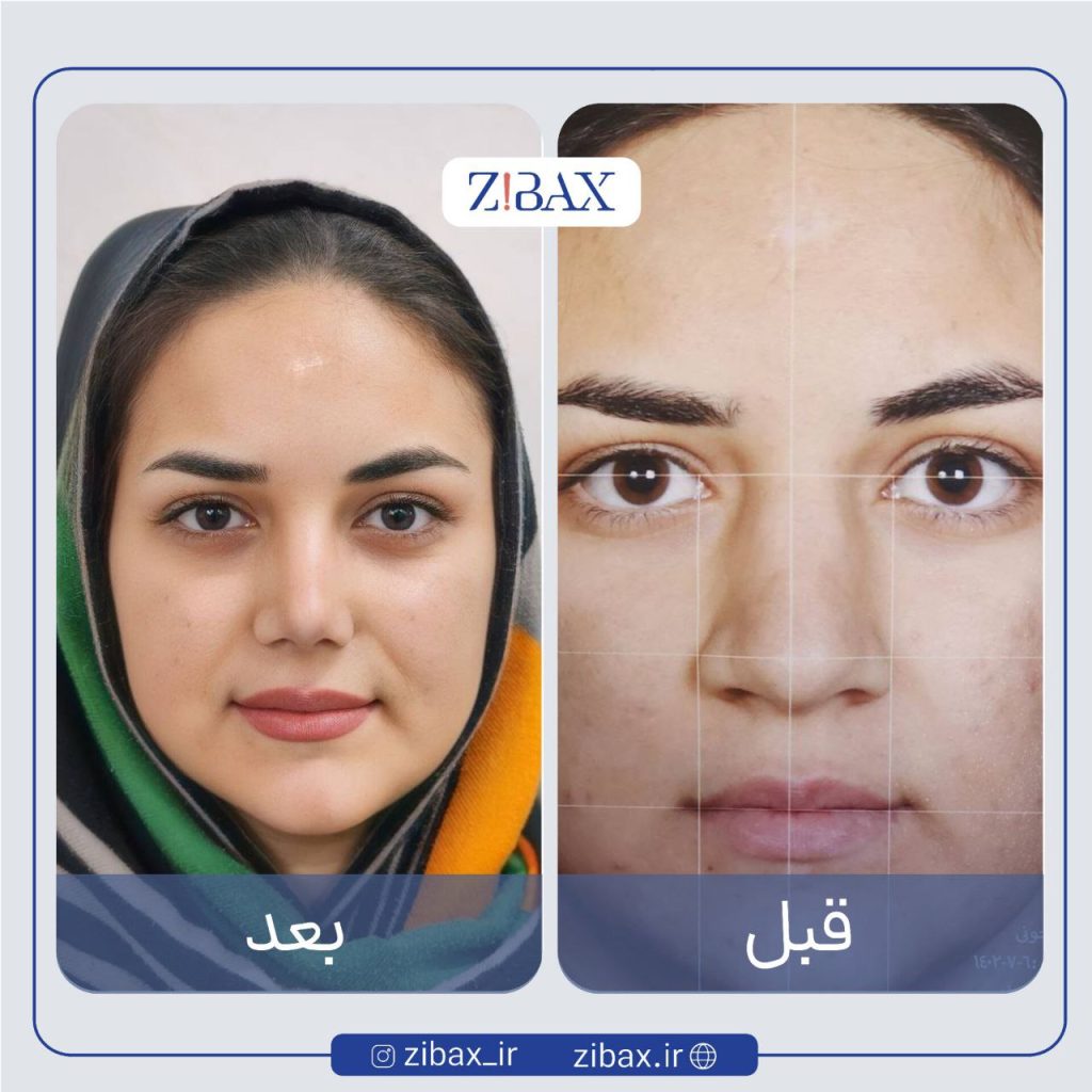 نمای روبرو از بینی گوشتی قبل و بعد عمل دماغ گوشتی در شیراز