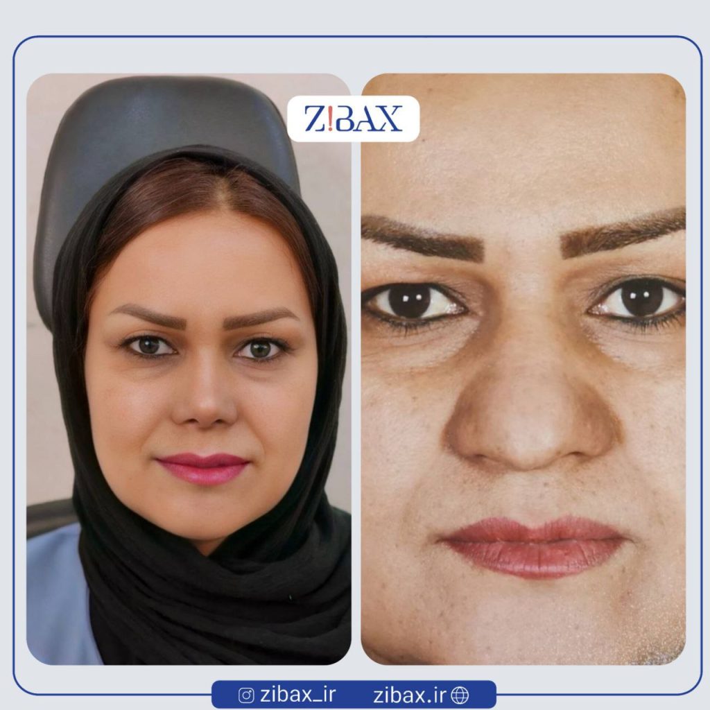 وضعیت بینی گوشتی قبل از جراحی رینوپلاستی با پره‌های پهن؛ مقایسه بعد از عمل بینی گوشتی در شیراز