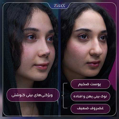 ویژگی بینی گوشتی