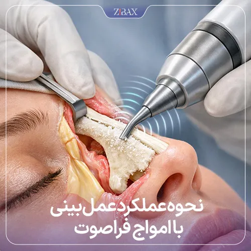 بررسی نحوه کار امواج فراصوت در رینوپلاستی