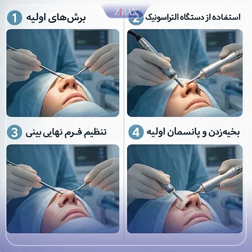 بررسی مراحل عمل بینی با امواج فراصوت