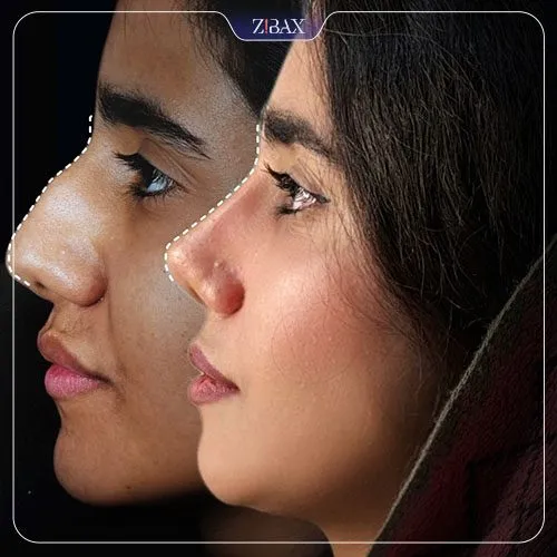 نمونه عمل جراحی بینی دکتر فرهاد محرابی سی سخت — تصویر 6