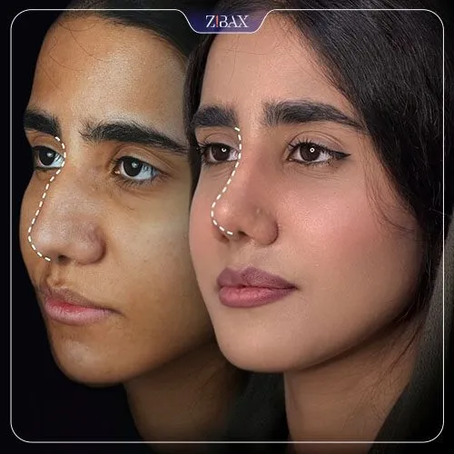 نمونه عمل جراحی بینی دکتر فرهاد محرابی سی سخت — تصویر 8