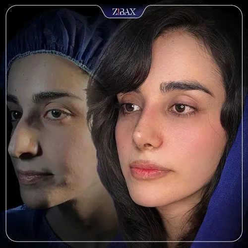 نمونه عمل جراحی بینی دکتر فرهاد محرابی سی سخت — تصویر 9