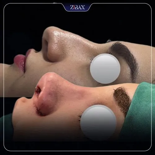 نتیجه جراحی