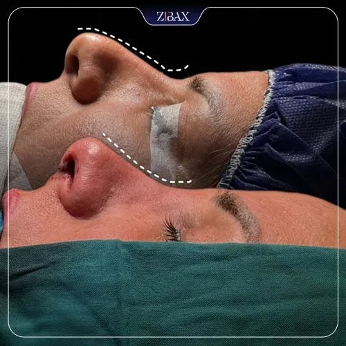 نمونه عمل جراحی بینی دکتر فرهاد محرابی سی سخت — تصویر 4