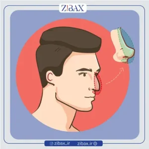 گوشت اضافه بعد از برداشتن بخیه بینی