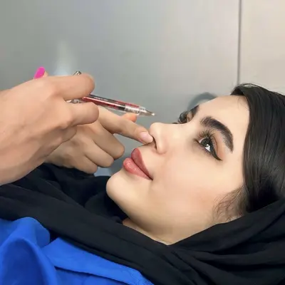 فیلر بینی قبل از عمل