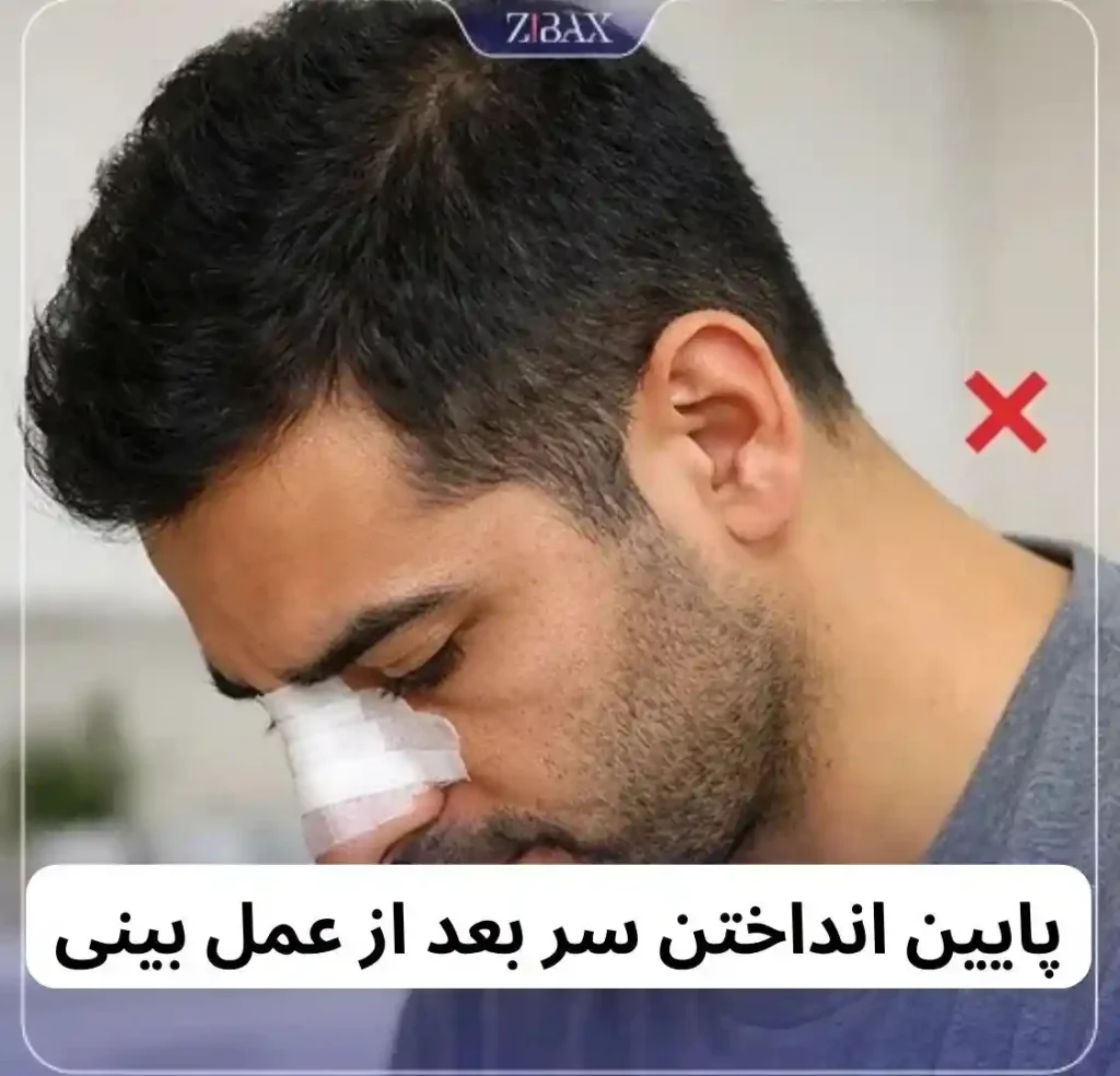 پایین انداختن سر بعد از عمل بینی