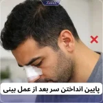پایین انداختن سر بعد از عمل بینی