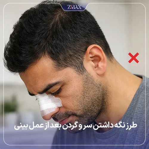 پایین نگرفتن سر بعد از عمل بینی