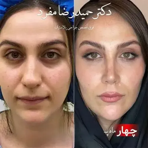 نمونه عمل جراحی بینی دکتر حمیدرضا مفرد — تصویر 1