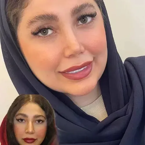 نمونه عمل جراحی بینی دکتر حمیدرضا مفرد — تصویر 10
