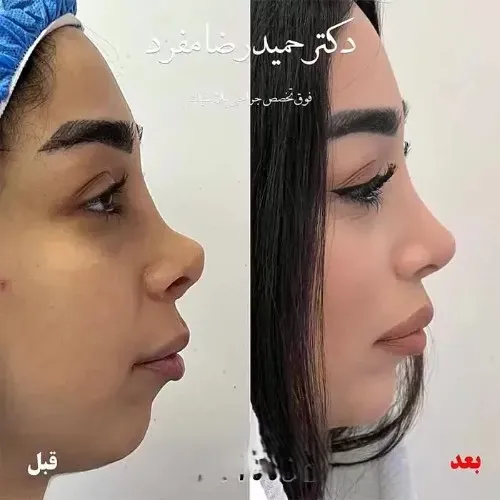 نمونه عمل جراحی بینی دکتر حمیدرضا مفرد — تصویر 2