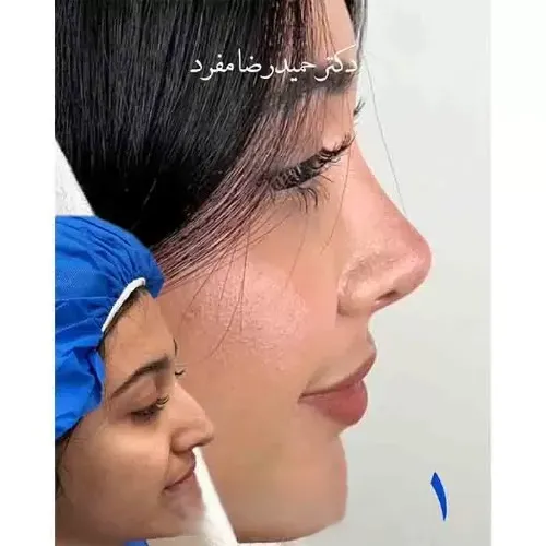 نمونه عمل جراحی بینی دکتر حمیدرضا مفرد — تصویر 3