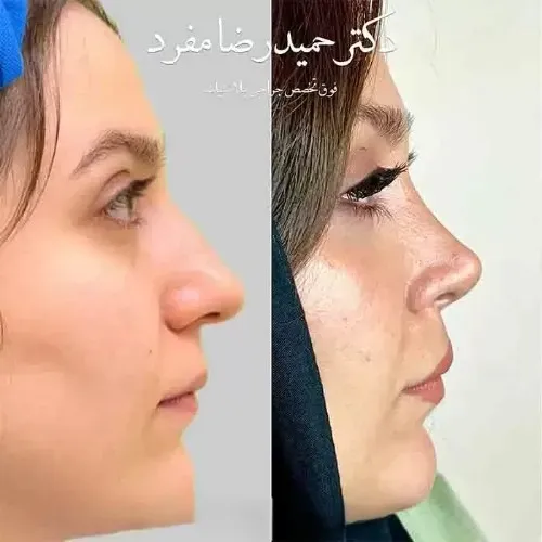 نمونه عمل جراحی بینی دکتر حمیدرضا مفرد — تصویر 4