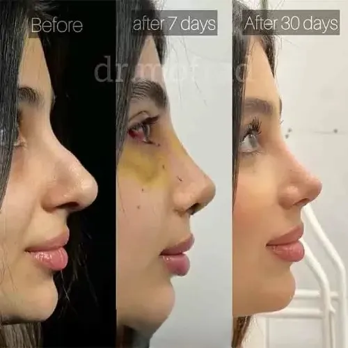 نمونه عمل جراحی بینی دکتر حمیدرضا مفرد — تصویر 5