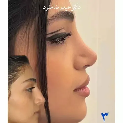 نمونه عمل جراحی بینی دکتر حمیدرضا مفرد — تصویر 6
