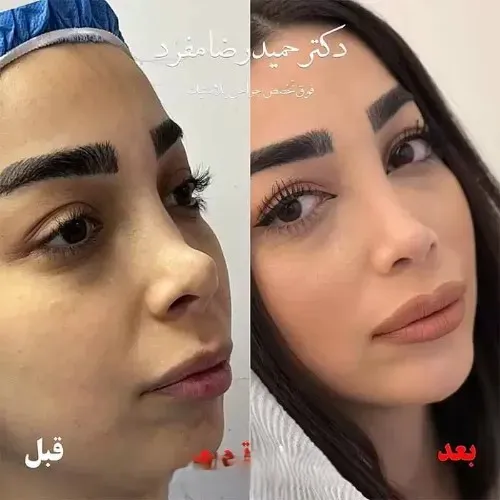 نمونه عمل جراحی بینی دکتر حمیدرضا مفرد — تصویر 7