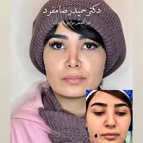 نمونه عمل جراحی بینی دکتر حمیدرضا مفرد — تصویر 8