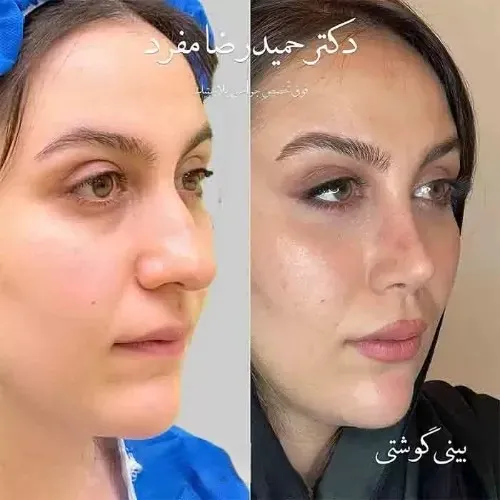 نمونه عمل جراحی بینی دکتر حمیدرضا مفرد — تصویر 9