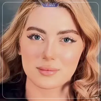 نمونه عمل جراحی بینی دکتر جواد خالقی — تصویر 3