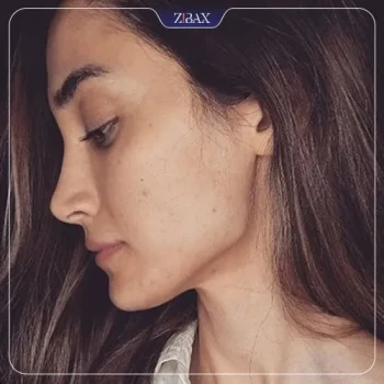 نمونه عمل جراحی بینی دکتر جواد خالقی — تصویر 4