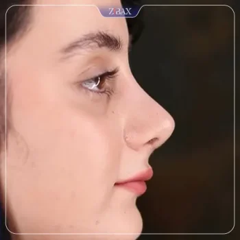 نمونه عمل جراحی بینی دکتر جواد خالقی — تصویر 5