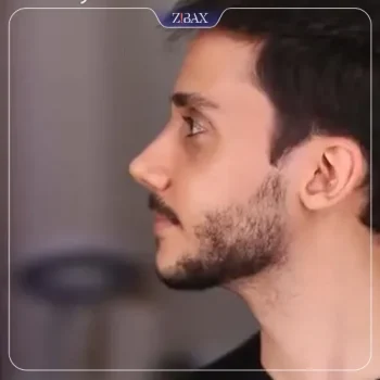 نمونه عمل جراحی بینی دکتر جواد خالقی — تصویر 6