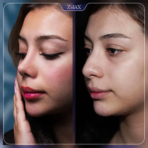 عکس بینی عمل شده با مشاوره زیباکس؛ مقاله جراحی ترمیمی بینی در تهران