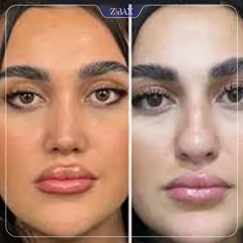 نمونه عمل جراحی بینی دکتر فرزان رضایی — تصویر 1