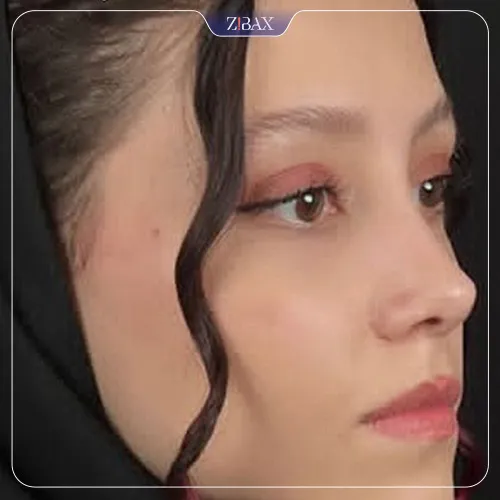 نمونه عمل جراحی بینی دکتر فرزان رضایی — تصویر 2