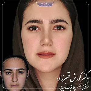 نمونه عمل جراحی بینی دکتر کورش قنبر زاده — تصویر 4