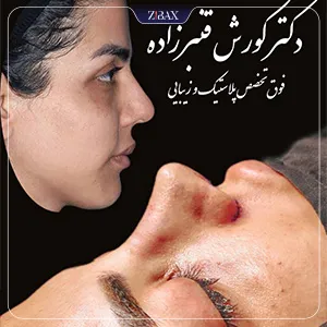 نمونه عمل جراحی بینی دکتر کورش قنبر زاده — تصویر 7