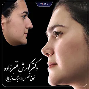 نمونه عمل جراحی بینی دکتر کورش قنبر زاده — تصویر 5