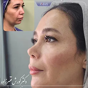 نمونه عمل جراحی بینی دکتر کورش قنبر زاده — تصویر 1