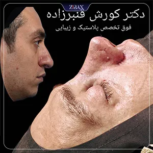 نمونه عمل جراحی بینی دکتر کورش قنبر زاده — تصویر 12