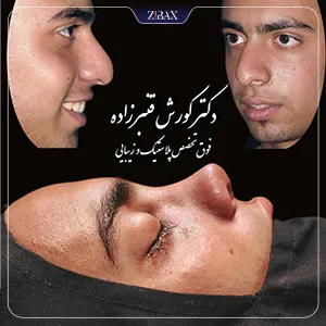 نمونه عمل جراحی بینی دکتر کورش قنبر زاده — تصویر 11