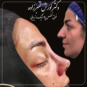 نمونه عمل جراحی بینی دکتر کورش قنبر زاده — تصویر 10