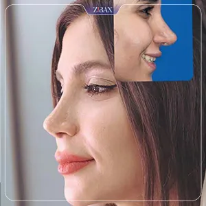 نمونه عمل جراحی بینی دکتر کورش قنبر زاده — تصویر 8