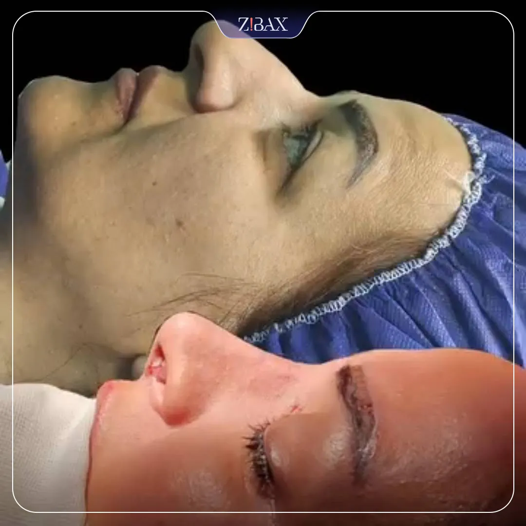 نمونه عمل جراحی بینی دکتر ساناز کیومرثی — تصویر 10