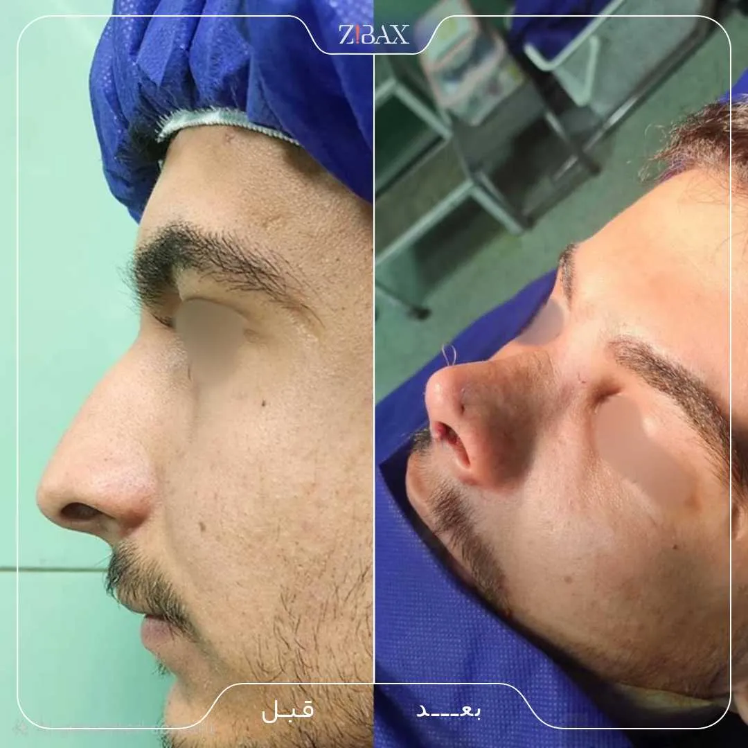 نمونه عمل جراحی بینی دکتر ساناز کیومرثی — تصویر 1