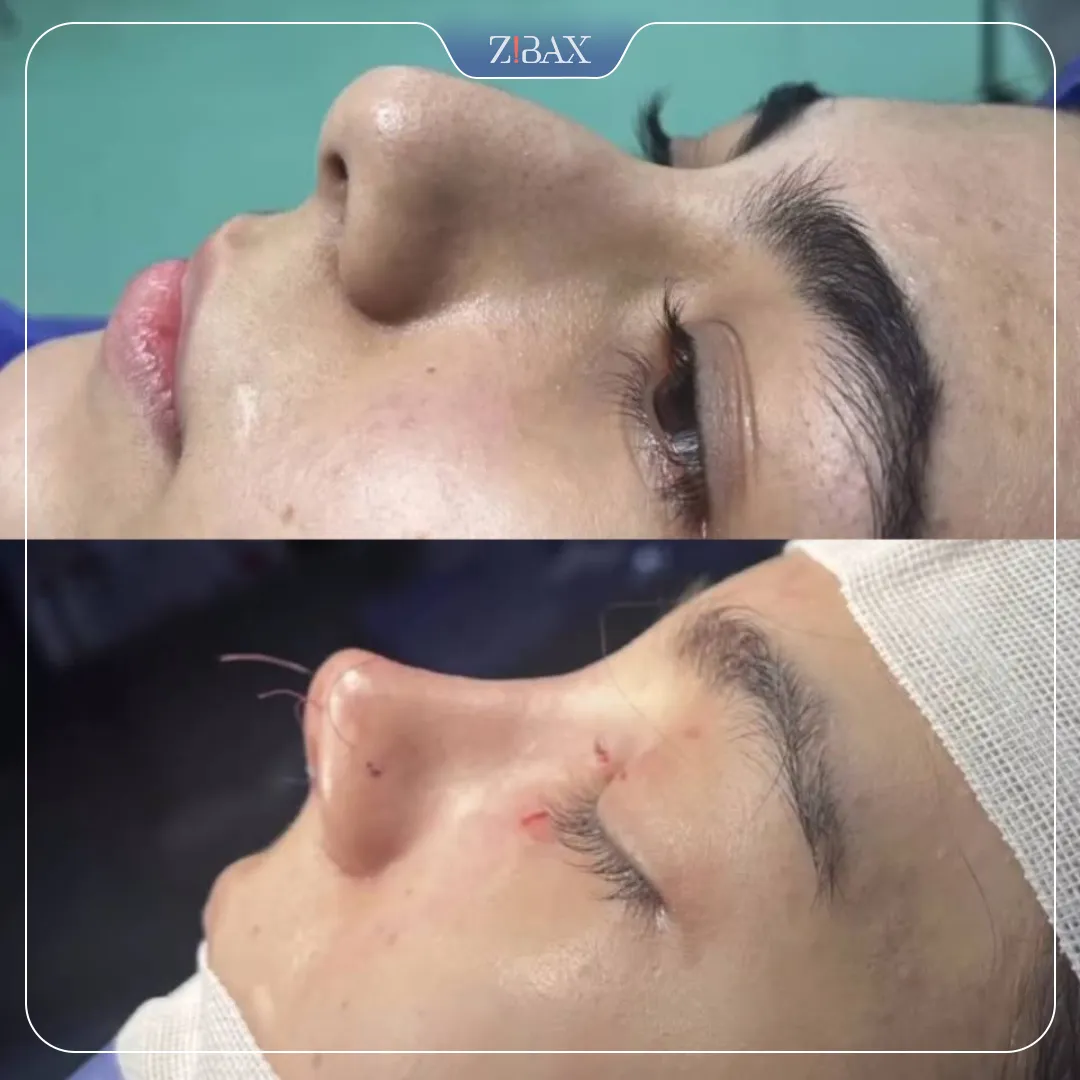 نمونه عمل جراحی بینی دکتر ساناز کیومرثی — تصویر 4