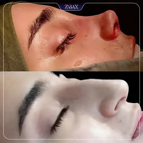 نمونه عمل جراحی بینی دکتر محمد بلاغی اینالویی — تصویر 11