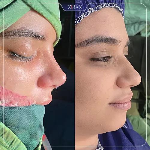 نمونه عمل جراحی بینی دکتر محمد بلاغی اینالویی — تصویر 3