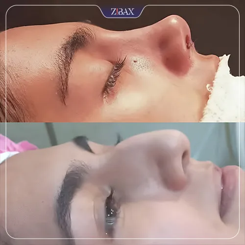 نمونه عمل جراحی بینی دکتر محمد بلاغی اینالویی — تصویر 4